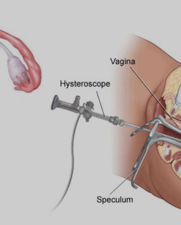 Histeroskopi