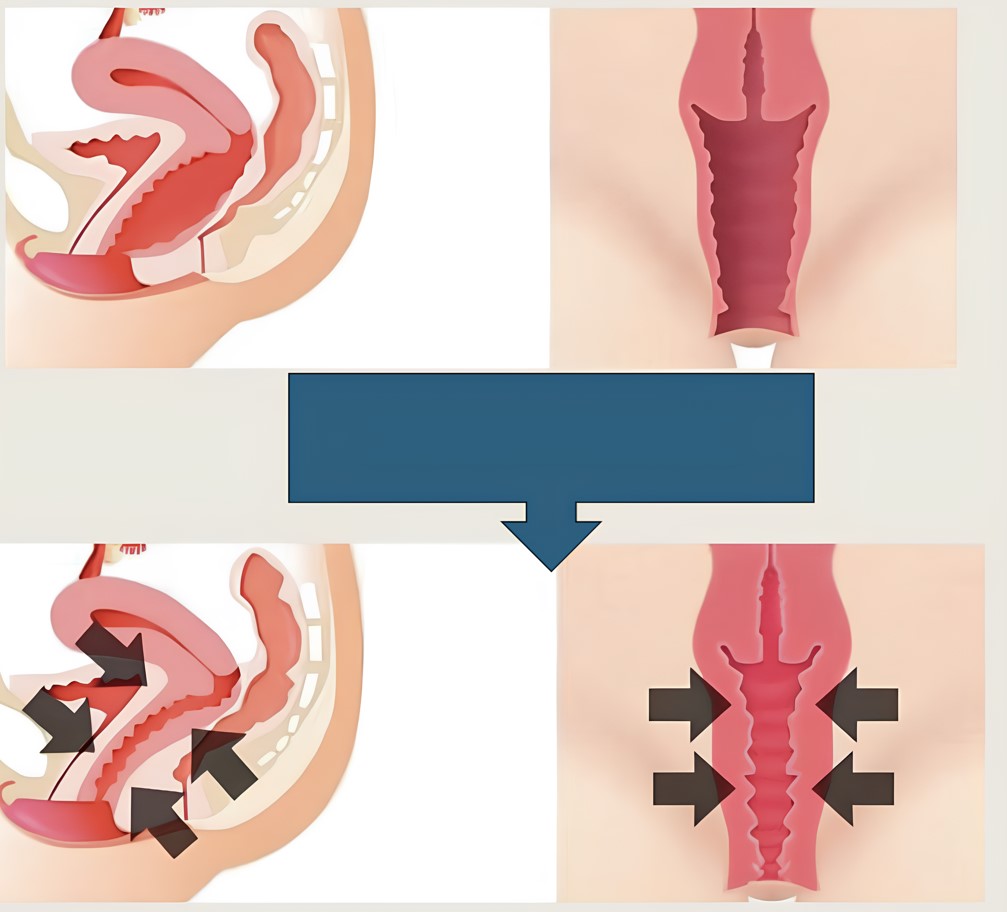 Vajina Daraltma Ameliyatı