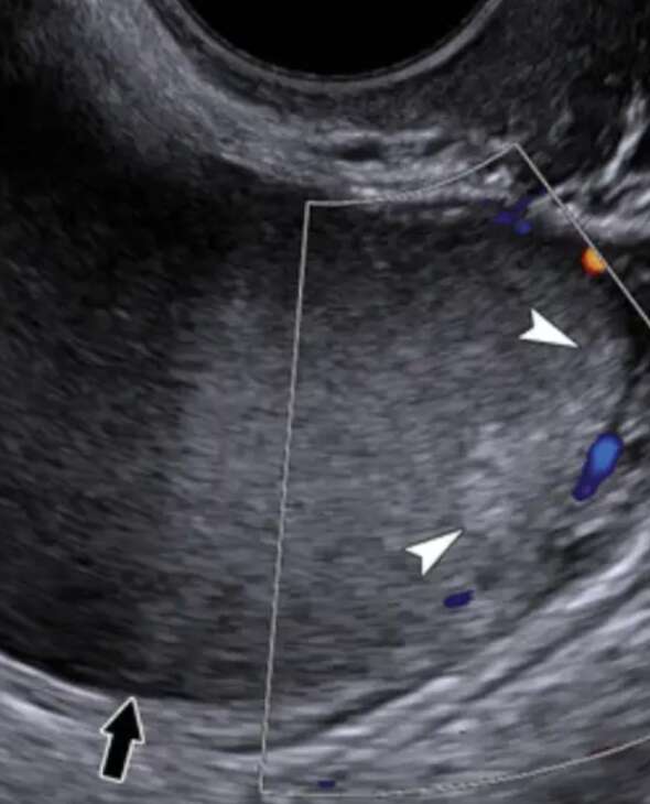 Bursa Endometrioz Tedavisi