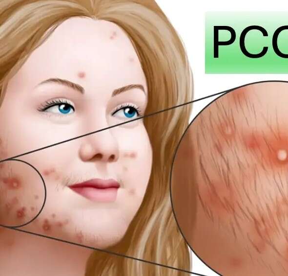 Bursa PCOS Tedavisi