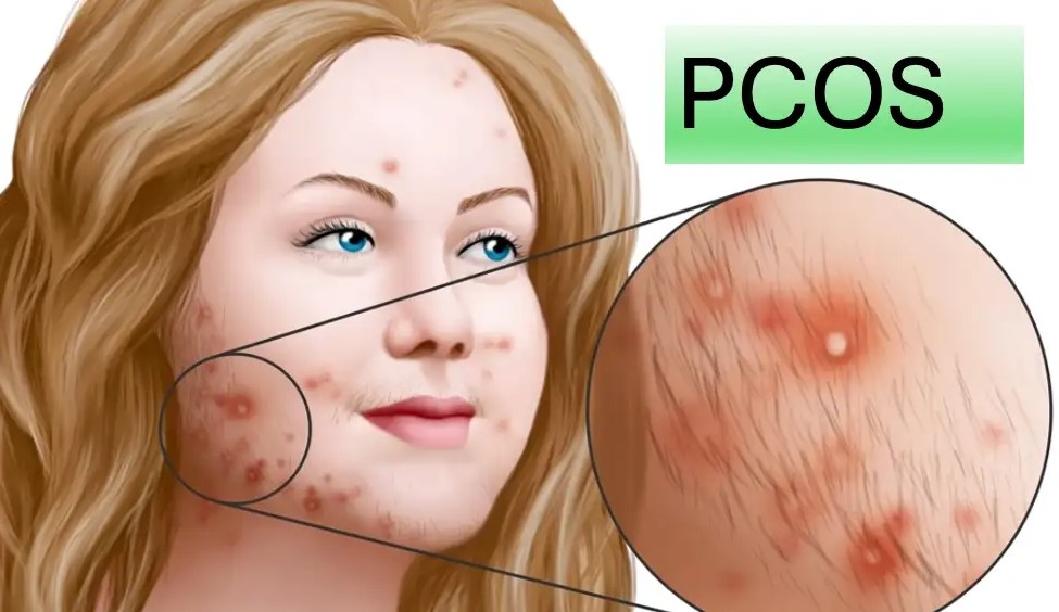 PCOS