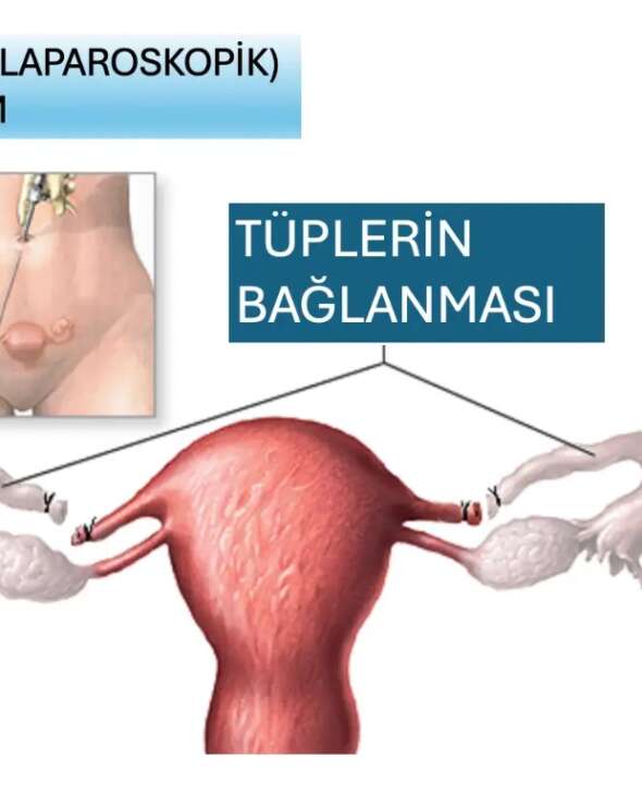 Bursa Tüp Bağlama Ameliyatı