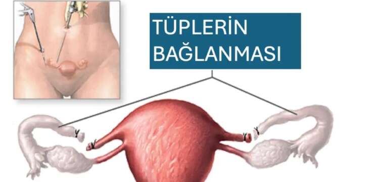 Bursa Tüp Bağlama Ameliyatı