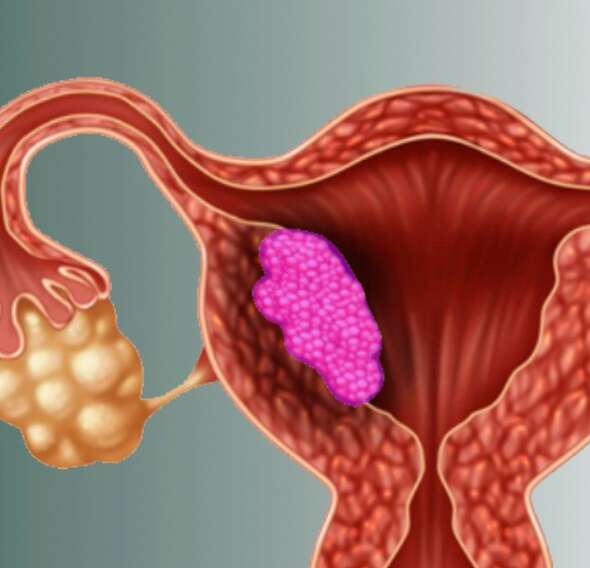 Endometrium Kanseri