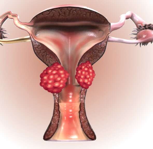 Rahim Ağzı (Serviks) Kanseri