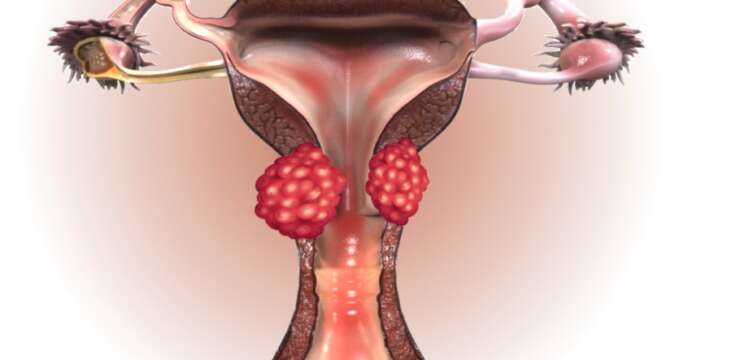 Rahim Ağzı (Serviks) Kanseri